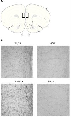 Prenatal Protein Malnutrition Produces Resistance to Distraction Similar to Noradrenergic Deafferentation of the Prelimbic Cortex in a Sustained Attention Task